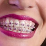 можно ли носить брекеты при беременности отзывы