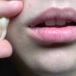 Можно ли удалять зуб при флюсе: показания и последствия