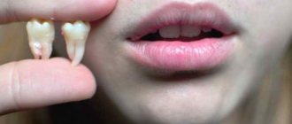 Можно ли удалять зуб при флюсе: показания и последствия