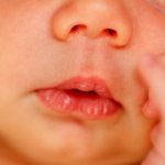 callus on the lip of a newborn