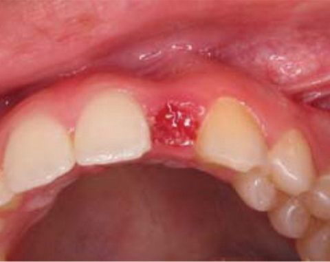 На фото лунка зуба на стадии заживления (2 неделя)