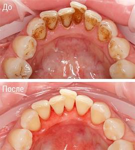 На фото показан внешний вид зубов до и после процедуры Air Flow.