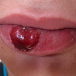 на губах сифилис