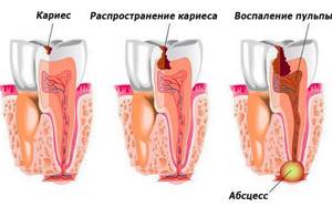На картинке показан процесс распространения кариеса внутрь зуба