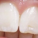 white spots on a person&#39;s teeth
