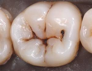 Начальный кариес в стадии темного пятна (пигментированного) в фиссурах зуба