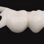 &#39;Do I need to remove the butterfly denture, photo &quot;before&quot;