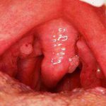 Нарост на язычке в горле что это