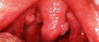 What is a growth on the tongue in the throat?