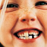Malocclusion
