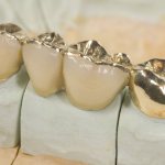 Disadvantages of a combined crown