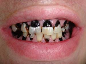 Некроз твердых тканей зубов