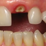 Необходимость коронки на зуб