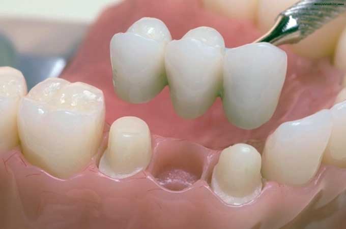 несъемные зубные протезы какие лучше