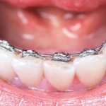 Invisible braces Win