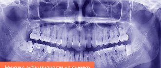 Нижние зубы мудрости на снимке