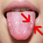 New growth on the tongue