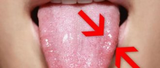 New growth on the tongue