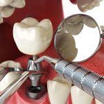 новые технологии имплантации в стоматологии