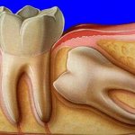 nuances of the appearance of wisdom teeth