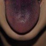 what does a dark coating of tongue mean?