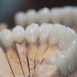 Области применения керамокомпозитных коронок