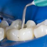 обработка зубного канала адгезивом