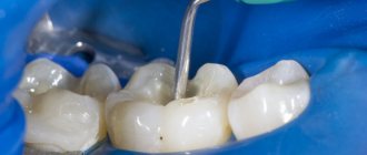 обработка зубного канала адгезивом