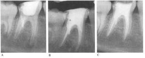 Перфорация корня зуба. Облитерация пульпарной камеры.