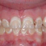 Очаговая деминерализация зубов