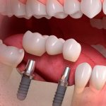 Single-phase dental implantation