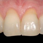 Exposure of tooth roots