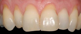 Оголение зубных корней