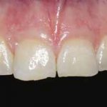 Окклюзионные виниры на дистальные зубы