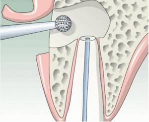 Операция цистэктомия зуба