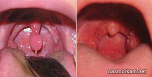 Опух язычок в горле: причины и лечение. Как снять воспаление?
