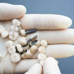 Reasons for installing an implant or a crown – which is better and why?