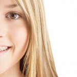 Особенности брекетов Inspire Ice