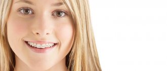 Features of Inspire Ice braces