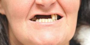Особенности отсутствия зубов