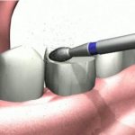 Особенности препарирования зубов под коронку