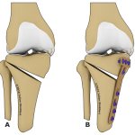 Остеотомия с металлоконструкцией.