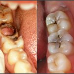 Acute and chronic form of pulpitis
