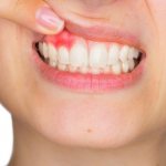 Острый гнойный периостит верхней челюсти