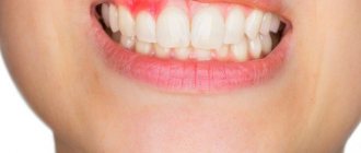 Acute purulent periostitis of the upper jaw