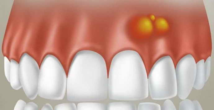 отек после удаления зуба является физиологическим состоянием