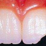 Откололся зуб во сне сонник