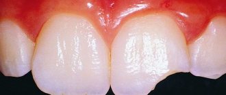 A tooth chipped off in a dream dream book