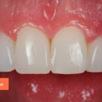 Отличие керамических от композитных виниров