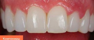 The difference between ceramic and composite veneers